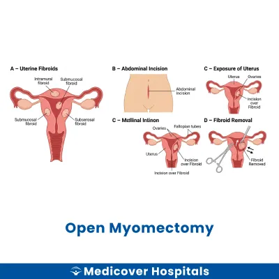 Open Myomectomy