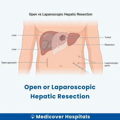 Open Or Laparoscopic Hepatic Resection