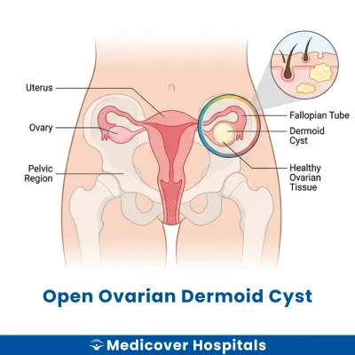 Open Ovarian Dermoid Cyst