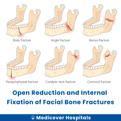 Open Reduction and Internal Fixation of Facial Bone Fractures