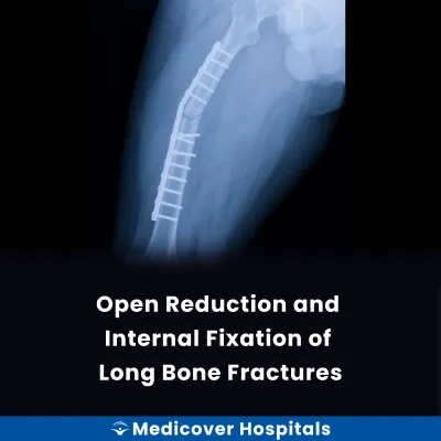 Open Reduction and Internal Fixation of Long Bone Fractures