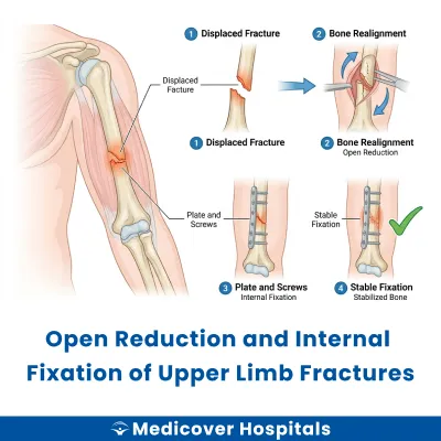 Open Reduction and Internal Fixation of Upper Limb Fractures