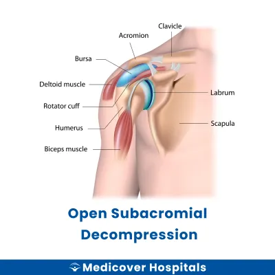 Open Subacromial Decompression