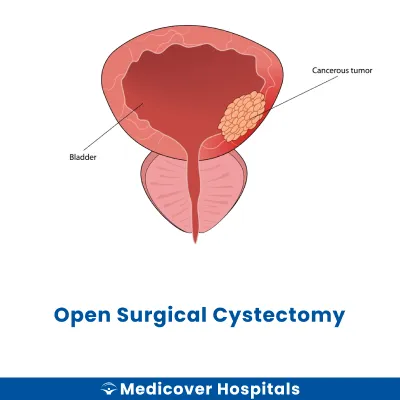 Open Surgical Cystectomy