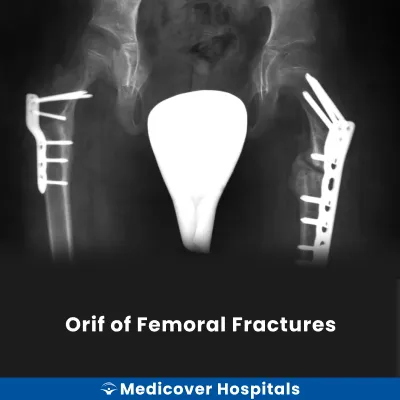 Orif of Femoral Fractures