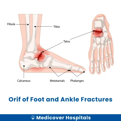 Orif of Foot and Ankle Fractures