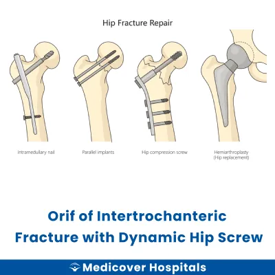 Orif of Intertrochanteric Fracture With Dynamic Hip Screw