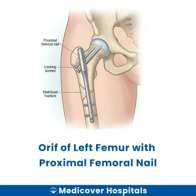 Orif of Left Femur With Proximal Femoral Nail