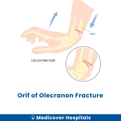 Orif of Olecranon Fracture
