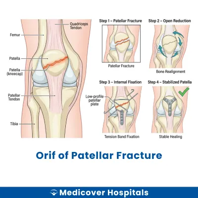 Orif of Patellar Fracture