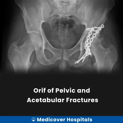 Orif of Pelvic and Acetabular Fractures