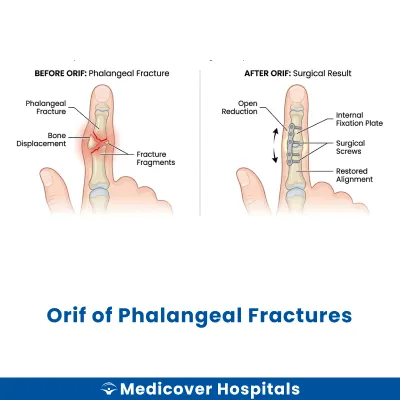 Orif of Phalangeal Fractures