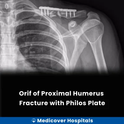 Orif of Proximal Humerus Fracture With Philos Plate