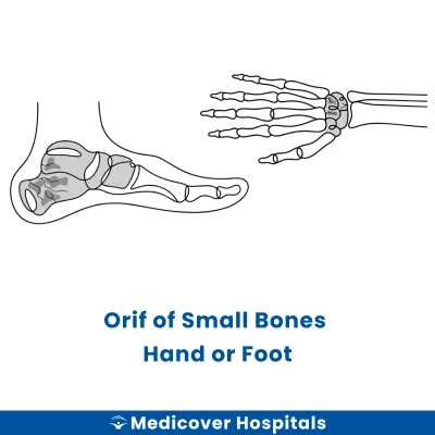 Orif of Small Bones Hand Or Foot