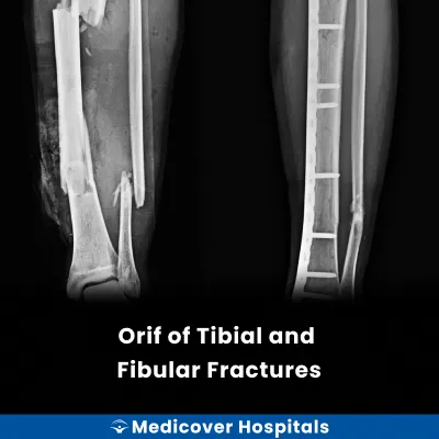Orif of Tibial and Fibular Fractures