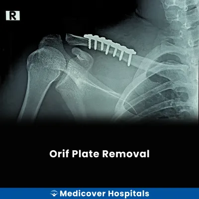 Orif Plate Removal