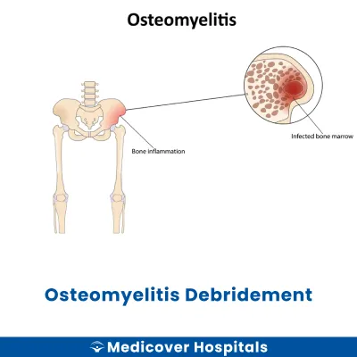 Osteomyelitis Debridement