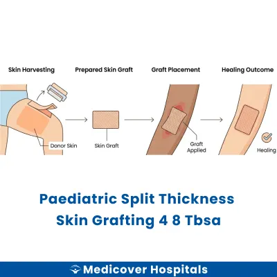 Paediatric Split Thickness Skin Grafting 4 8 Tbsa