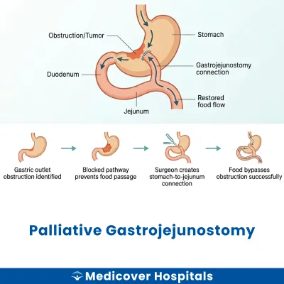 Palliative Gastrojejunostomy
