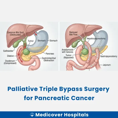 Palliative Triple Bypass Surgery for Pancreatic Cancer
