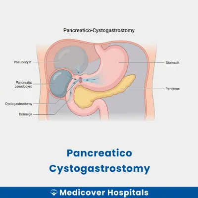 Pancreatico Cystogastrostomy