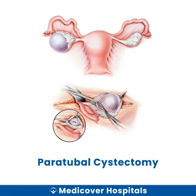 Paratubal Cystectomy