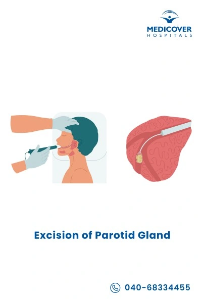 parotidectomy