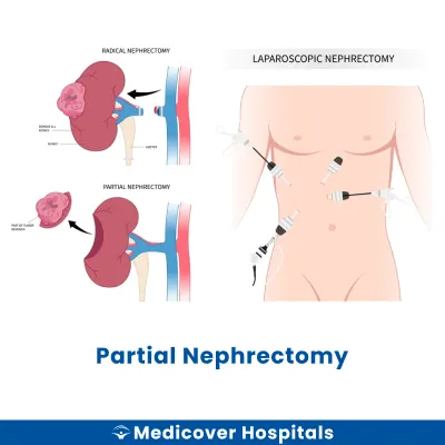Partial Nephrectomy