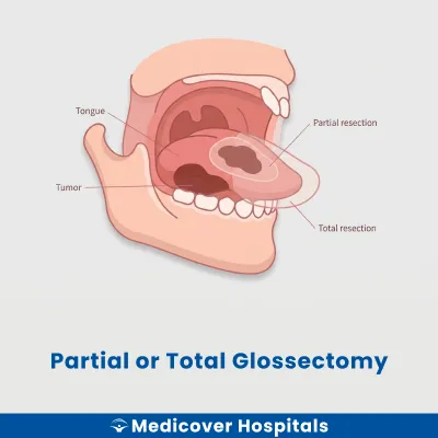 Partial Or Total Glossectomy