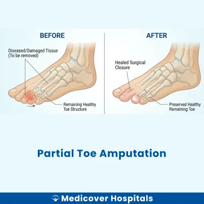 Partial Toe Amputation