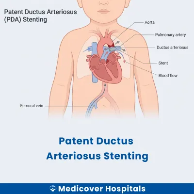 Patent Ductus Arteriosus Stenting