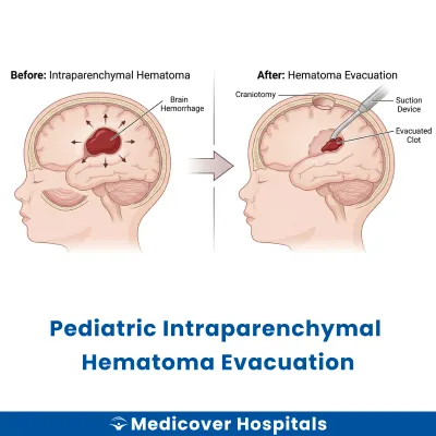 Pediatric Intraparenchymal Hematoma Evacuation