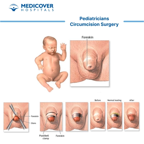 Circumcision in children