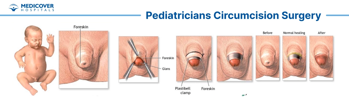 Circumcision in children