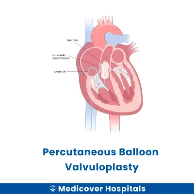 Percutaneous Balloon Valvuloplasty