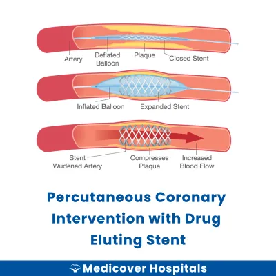 Percutaneous Coronary Intervention With Drug Eluting Stent