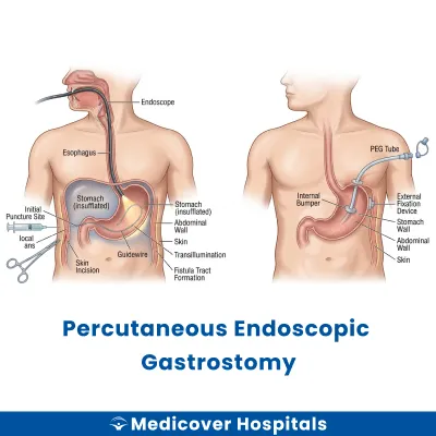 Percutaneous Endoscopic Gastrostomy