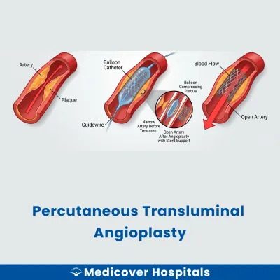 Percutaneous Transluminal Angioplasty