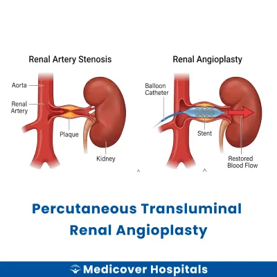 Percutaneous Transluminal Renal Angioplasty