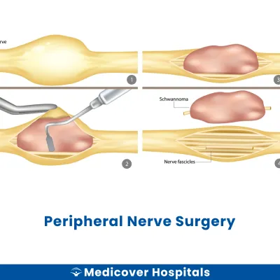 Peripheral Nerve Surgery