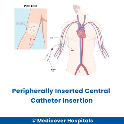 Peripherally Inserted Central Catheter Insertion