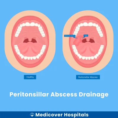 Peritonsillar Abscess Drainage
