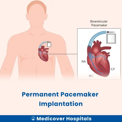Permanent Pacemaker Implantation