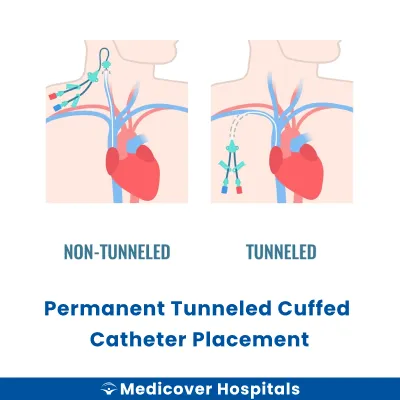 Permanent Tunneled Cuffed Catheter Placement
