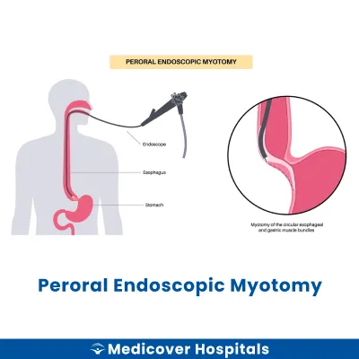 Peroral Endoscopic Myotomy