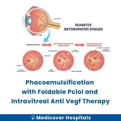 Phacoemulsification With Foldable Pciol and Intravitreal Anti Vegf Therapy