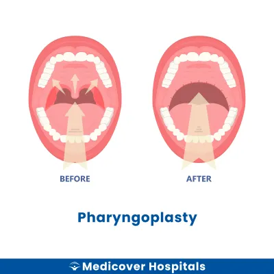 Pharyngoplasty