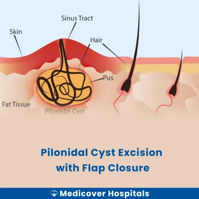 Pilonidal Cyst Excision With Flap Closure