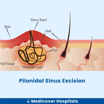 Pilonidal Sinus Excision