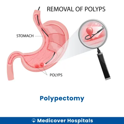 Polypectomy